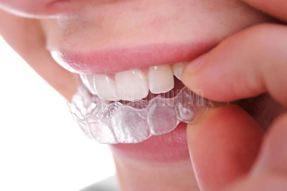 Niềng răng 3D Clear và là phương pháp chỉnh nha sử dụng khay trong suốt