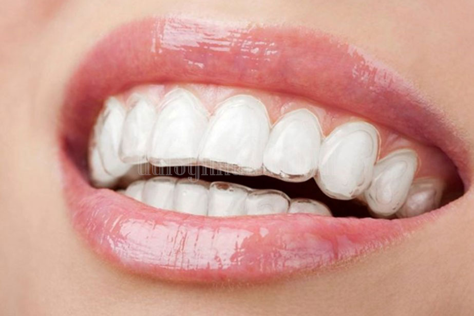  Niềng răng 3D Clear và Invisalign có gì khác biệt?