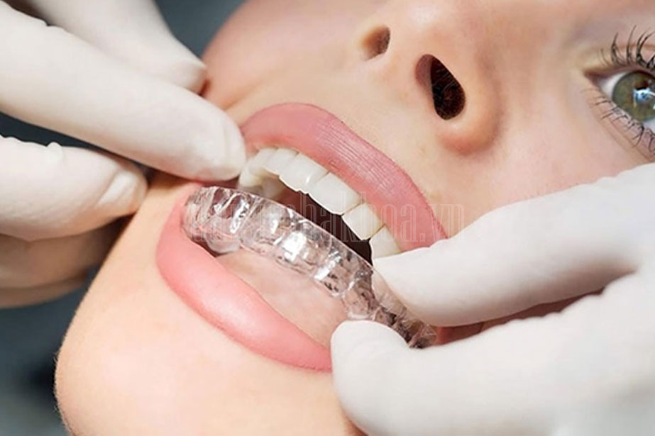 Niềng răng Invisalign là lựa chọn hàng đầu của các chuyên gia nha khoa