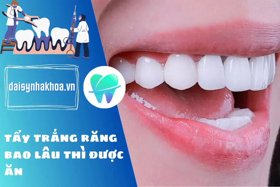 Trong 2 giờ đầu tiên sau khi tẩy trắng răng, bạn không nên ăn uống vì lúc này răng rất dễ bị nhiễm màu