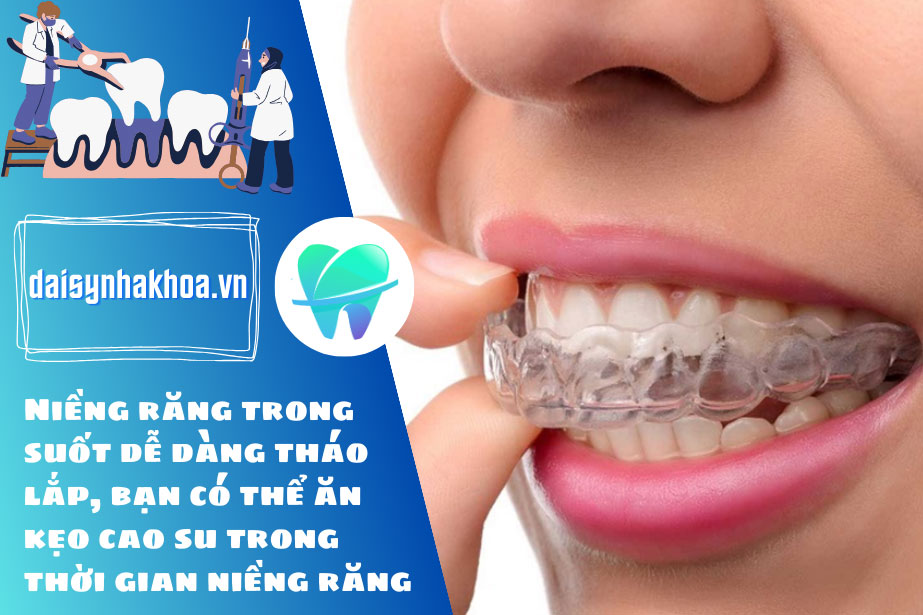 Niềng răng trong suốt dễ dàng tháo lắp, bạn có thể ăn kẹo cao su trong thời gian niềng răng.