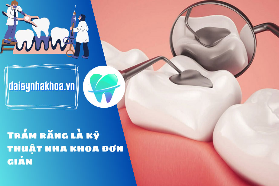 Trám răng là kỹ thuật nha khoa đơn giản tuy nhiên cần thực hiện đúng quy trình để đảm bảo an toàn và mang lại hiệu quả cao.