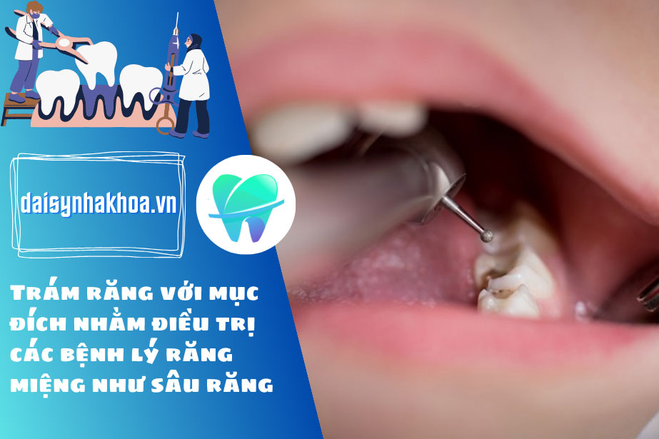 Trám răng với mục đích nhằm điều trị các bệnh lý răng miệng như sâu răng, răng sứt mẻ,... và bác sĩ chỉ định sẽ được hưởng bảo hiểm y tế.