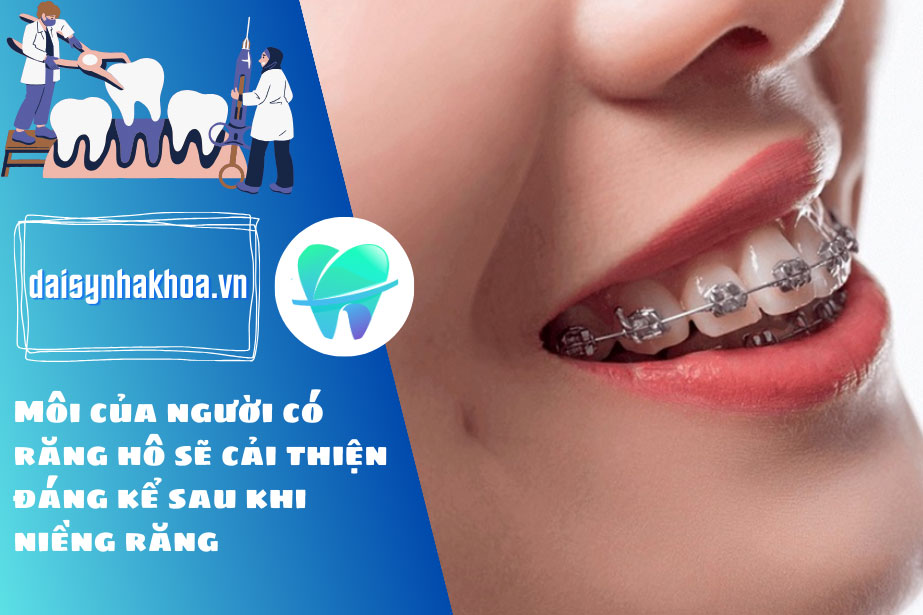 Môi của người có răng hô sẽ cải thiện đáng kể sau khi niềng răng