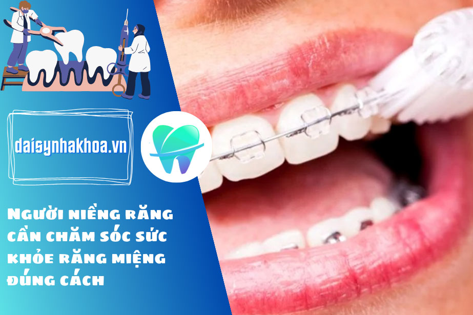 Người niềng răng cần chăm sóc sức khỏe răng miệng đúng cách để duy trì sức khỏe răng miệng