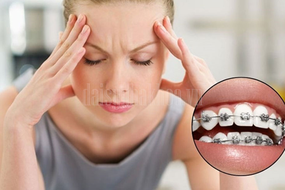 [Lý giải] Niềng răng có ảnh hưởng đến thần kinh không?