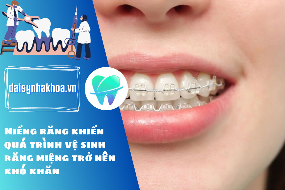 Niềng răng khiến quá trình vệ sinh răng miệng trở nên khó khăn hơn do vướng víu các khí cụ chỉnh nha.