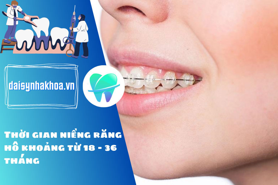 Thời gian niềng răng hô khoảng từ 18 - 36 tháng, tuy nhiên còn tùy thuộc vào nhiều yếu tố.