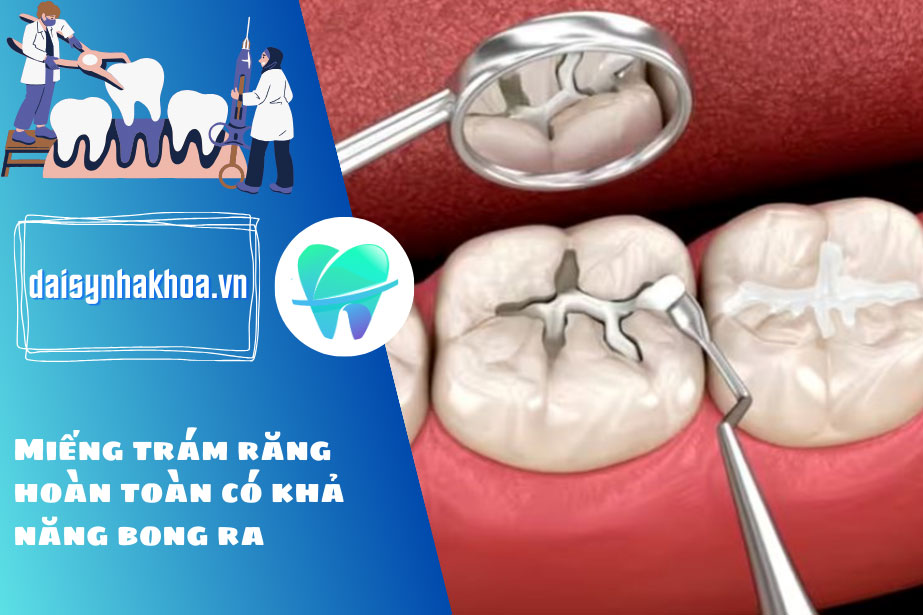 Miếng trám răng hoàn toàn có khả năng bong ra vì nhiều nguyên nhân khác nhau