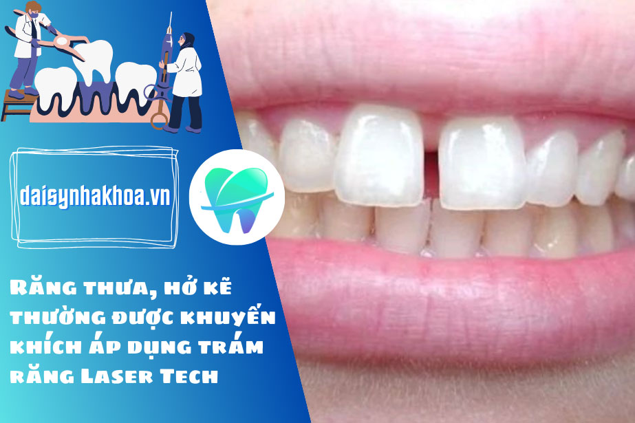 Răng thưa, hở kẽ thường được khuyến khích áp dụng trám răng Laser Tech