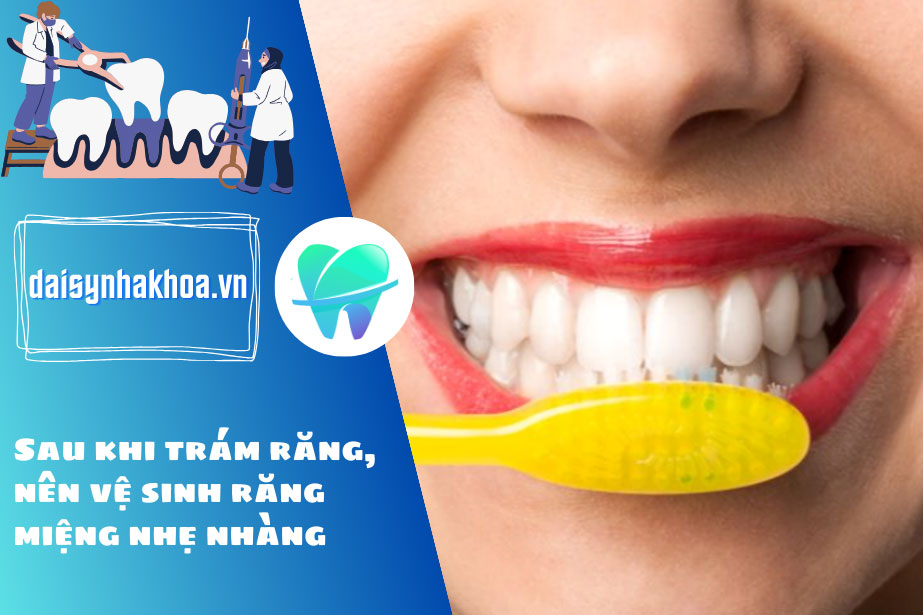 Sau khi trám răng, nên vệ sinh răng miệng nhẹ nhàng để không ảnh hưởng miếng trám